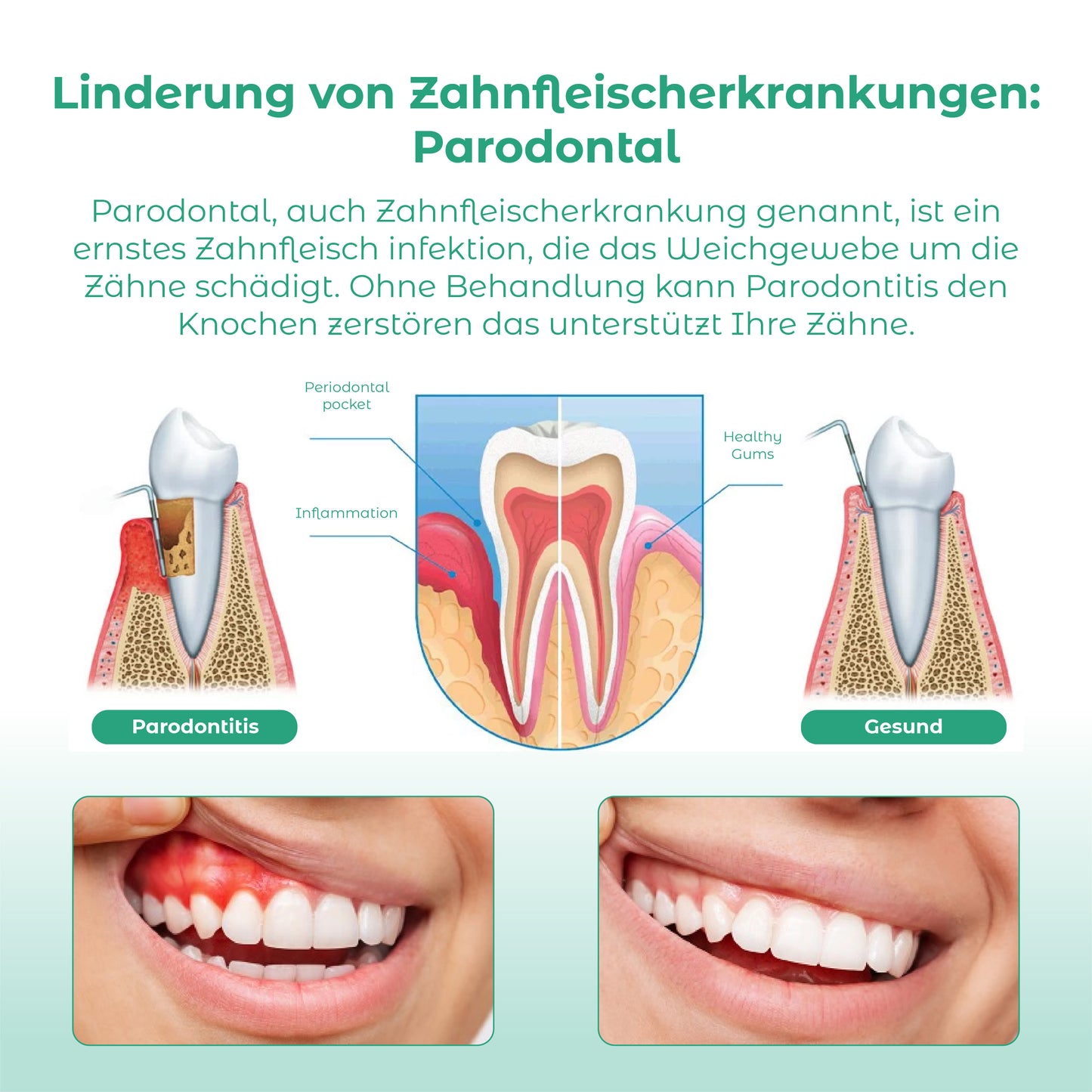 ATTDX Auffrischen Aufhellende Zahnfleischpflege Pellets