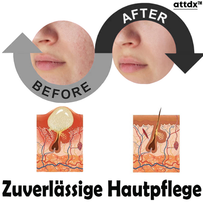 ATTDX Hautunreinheit Akne Jugend Serum