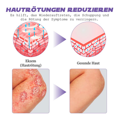 ATTDX SofortigeErleichterung Ekzem ViolaCreme