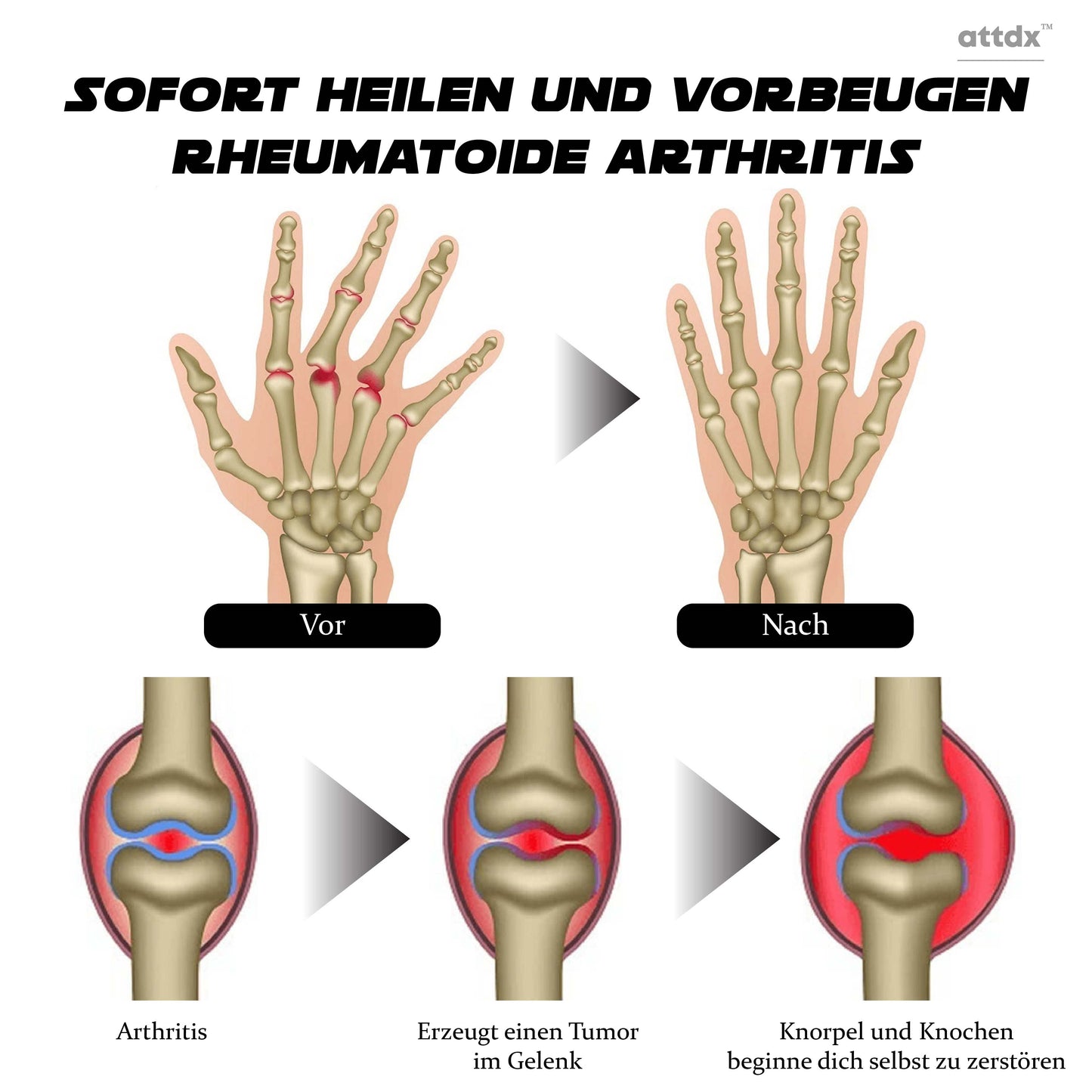 ATTDX ProRelief Kräuter Gelenkerholungscreme