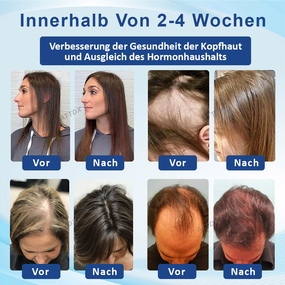 ATTDX™  Alopecia Wiederherstellungs Haarwuchscreme