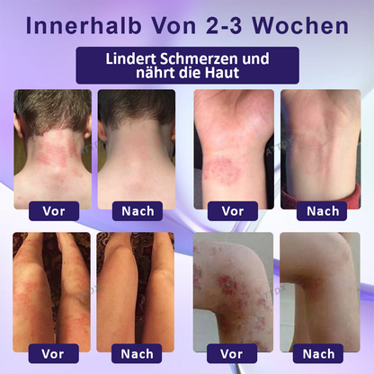 ATTDX™ Violette Beruhigende Hauttherapie Salbe