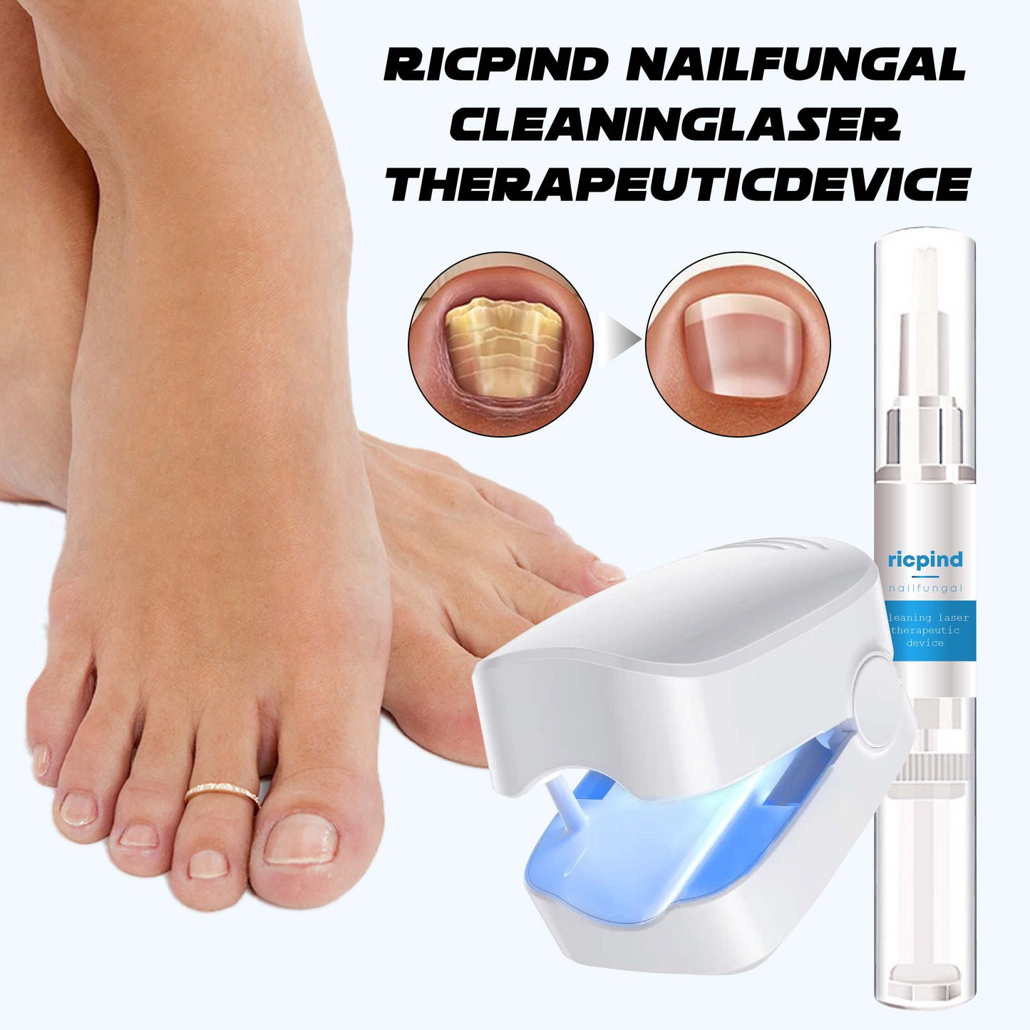 Ricpind NailFungal CleaningLaser TherapeuticDevice